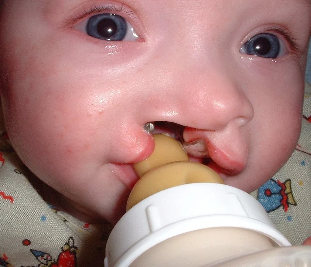 Cleft palate baby, cleft lip baby